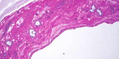 The image features a close-up of a pink tissue with a purple hue, possibly a piece of tissue or a blood vessel. The tissue appears to be swollen and has a slightly rough texture. The primary subject is the pink tissue, which is the main focus of the image. The setting is a white background, which provides a clean and uncluttered environment for the tissue to be displayed. The visual style is a close-up, which emphasizes the details of the tissue.